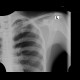 Osteopathia striata, systemic bone disorder: X-ray - Plain radiograph